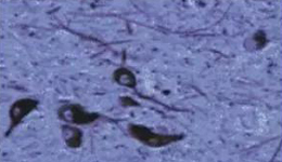 正凡人：：黑质神经元保存