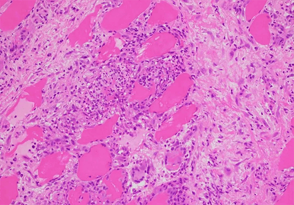 【豪门国际官网助力】治疗结节病的KBMAB-16获FDA批准临床
